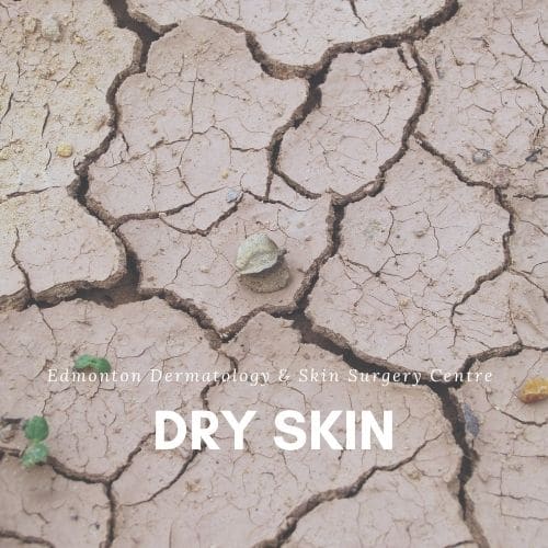 Acne Scar Treatment Edmonton Acne Scars Are Visible on Dry Skin