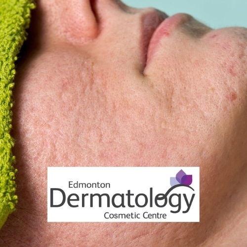 Acne Scar Treatment Edmonton Ways to Minimize Acne Scarring