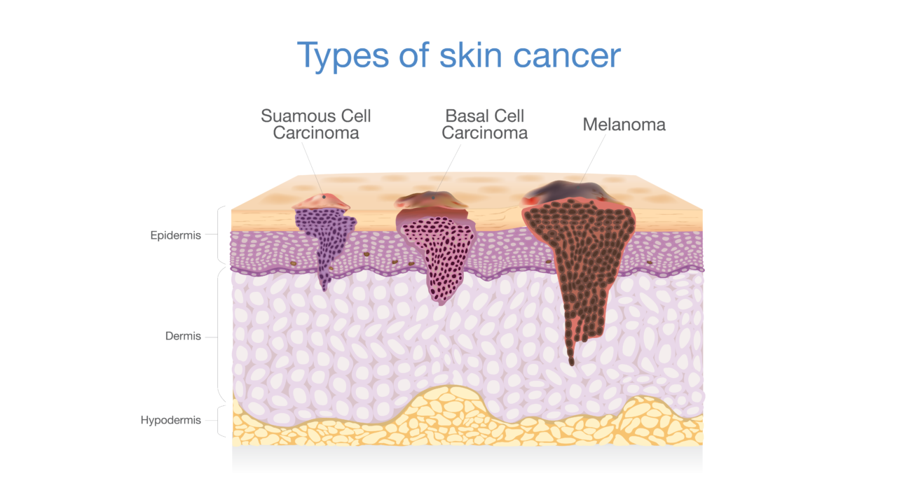 Types Of Skin Cancer Edmonton Dermatology