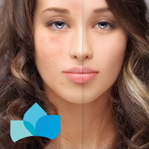 How to Address Acne Scarring with Anti-aging Methods