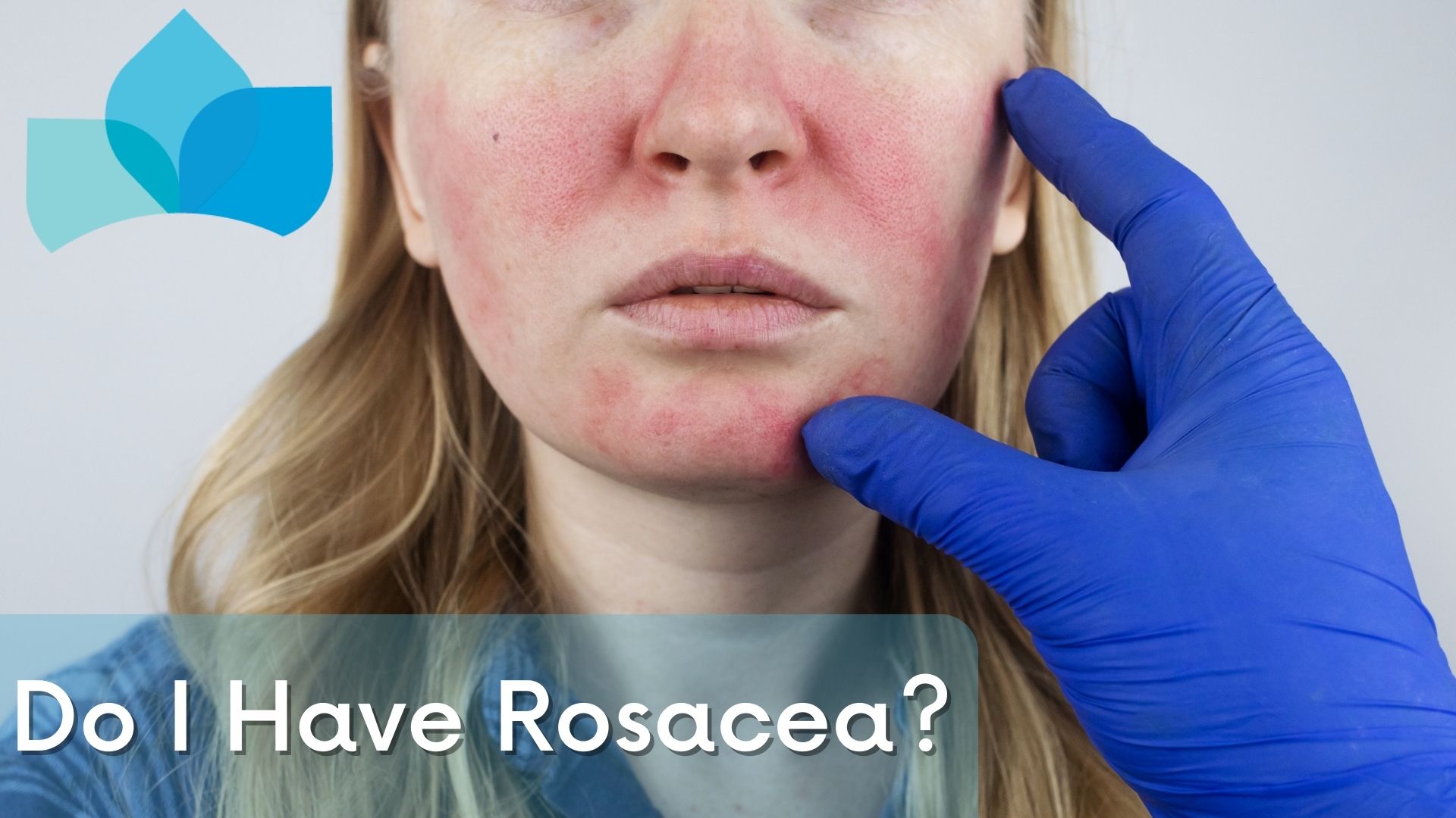 Do I have Rosacea? by Edmonton Dermatology