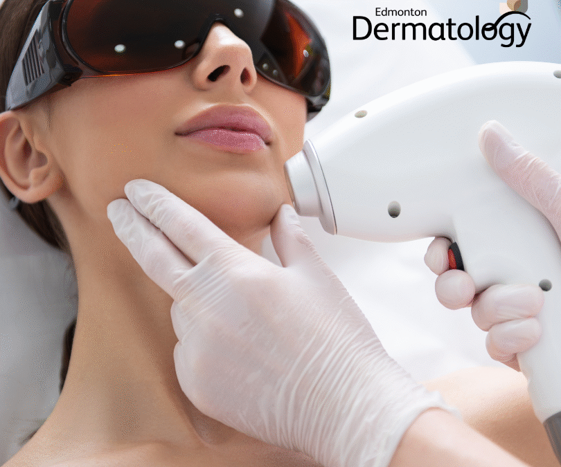 Fraxel Laser Resurfacing: What to Expect from Your First Fraxel Laser Session in Edmonton!
