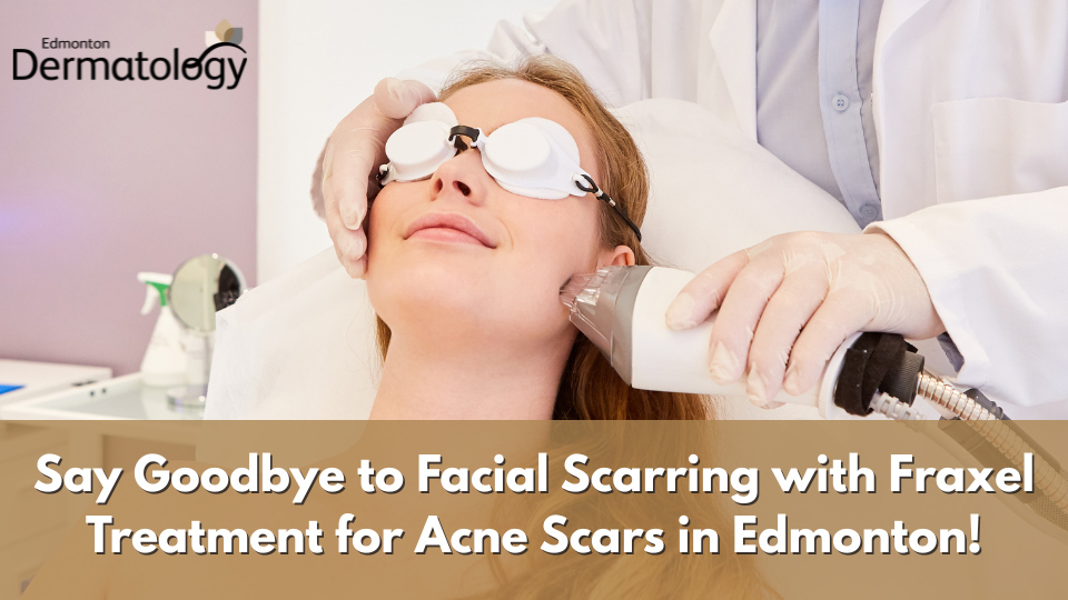 Fraxel treatment for acne scars in Edmonton