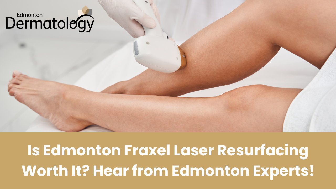 Edmonton Fraxel Laser Resurfacing